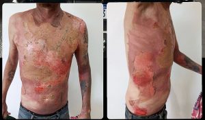 Mulher joga água fervente em vizinho enquanto ele dormia e acaba presa